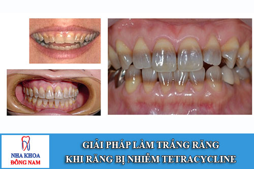 giải pháp làm trắng răng khi răng bị nhiễm tetracycline