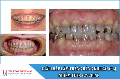 giải pháp làm trắng răng khi răng bị nhiễm tetracycline
