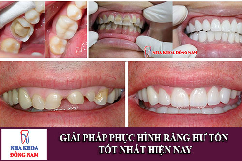 giải pháp phục hình răng hư tổn tốt nhất hiện nay