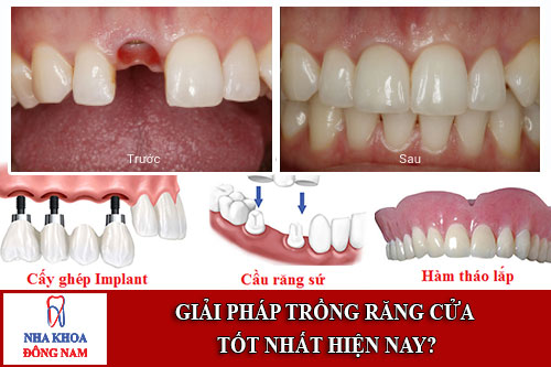 giải pháp trồng răng cửa tốt nhất hiện nay