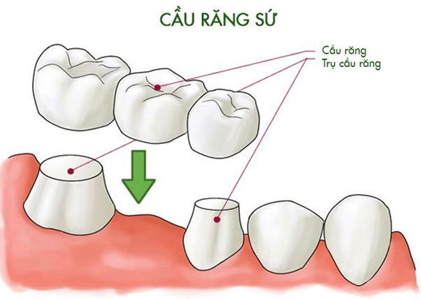 Hình ảnh mô phỏng kỹ thuật làm cầu răng sứ