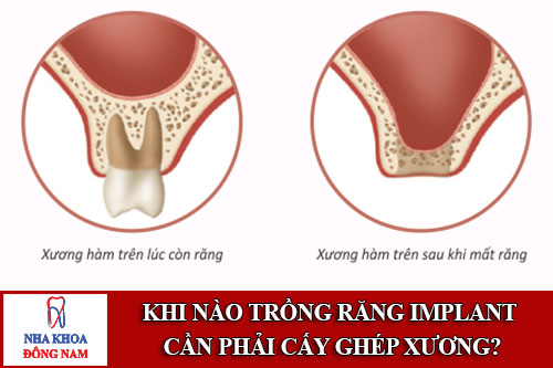 Khi nào trồng răng implant cần phải cấy ghép xương