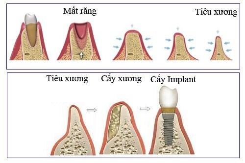 khi nào Trồng răng Implant cần cấy ghép xương 4