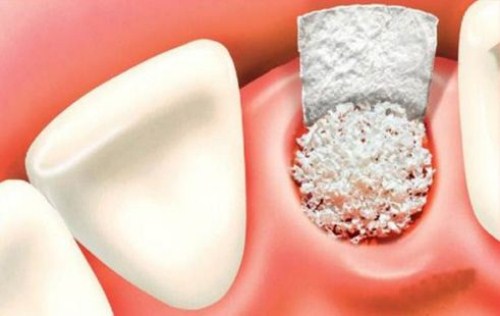 khi nào Trồng răng Implant cần cấy ghép xương 6