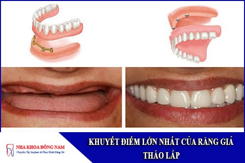 khuyết điểm lớn nhất của răng giả tháo lắp