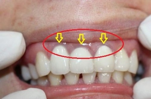 hiện tượng đen viền nướu