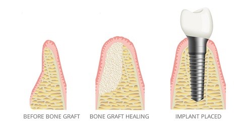 trồng răng implant