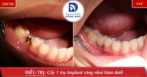 cấy 1 trụ implant răng nhai hàm dưới