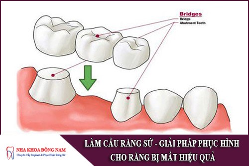làm cầu răng sứ - giải pháp phục hình răng đã mất hiệu quả