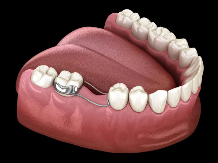 Làm hàm giữ khoảng cho trường hợp mất răng sớm chưa đủ tuổi trồng Implant