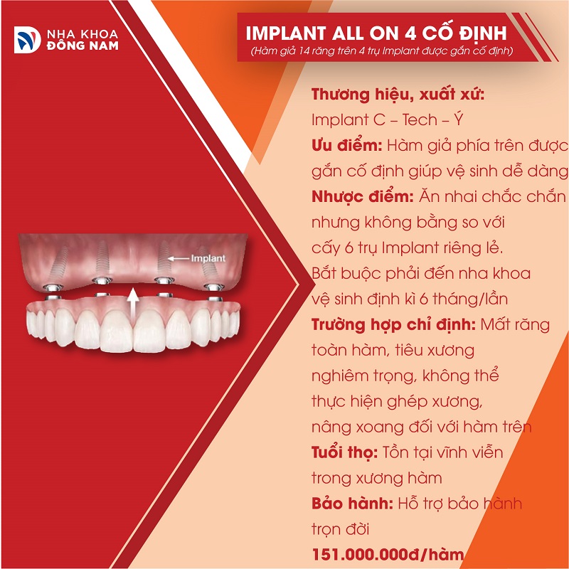 đặc điểm của implant all on 4 cố định