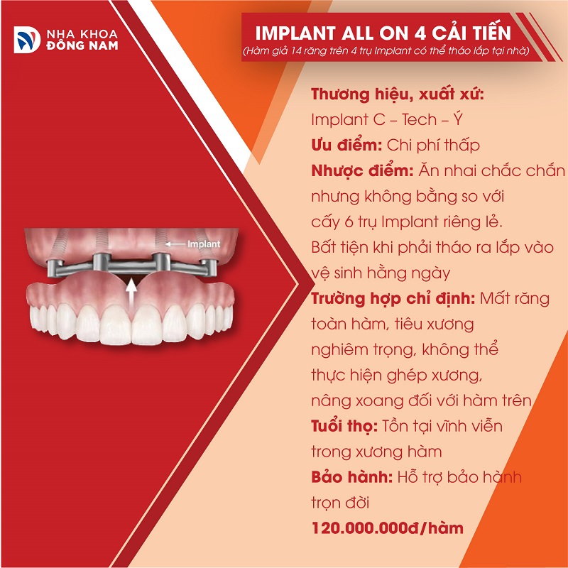 đặc điểm của implant all on 4 tháo lắp