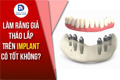 Làm Răng Giả Tháo Lắp Trên Implant có tốt không?