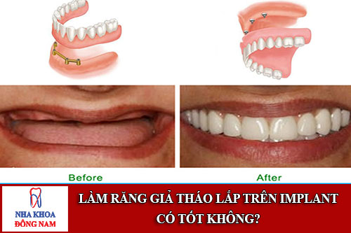 làm răng giả tháo lắp trên implant có tốt không