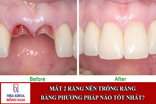 Phương pháp trồng răng nào tốt nhất khi bị mất 2 răng