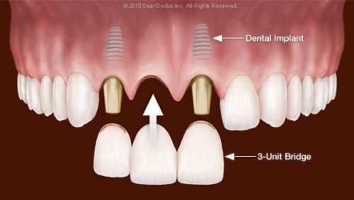 mô phỏng cấy ghép răng implant