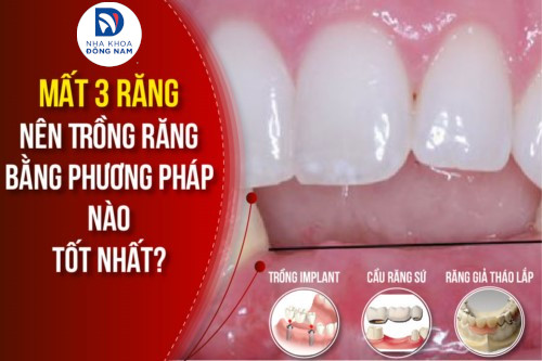 mất 3 răng nên trồng răng bằng phương pháp nào tốt nhất hiện nay