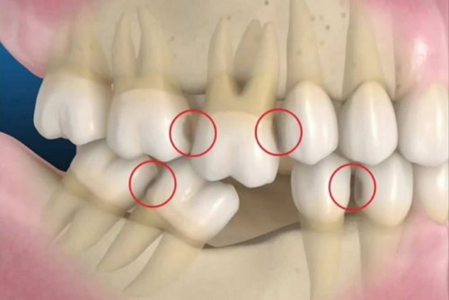 mất răng gây xáo trộn khớp cắn
