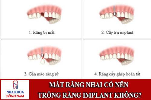 Mất răng nhai có nên trồng răng implant không