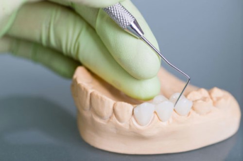Mẫu răng sứ sau khi được chế tác tại nha khoa