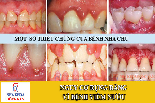nguy cơ rụng răng vì bệnh viêm nướu