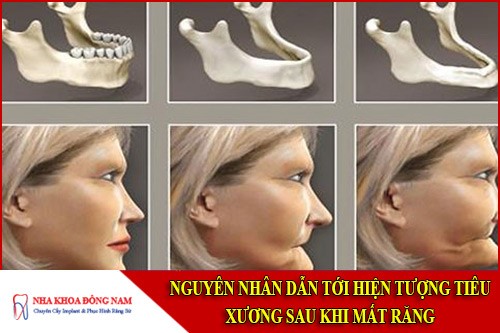 nguyên nhân dẫn tới hiện tượng tiêu xương sau khi mất răng