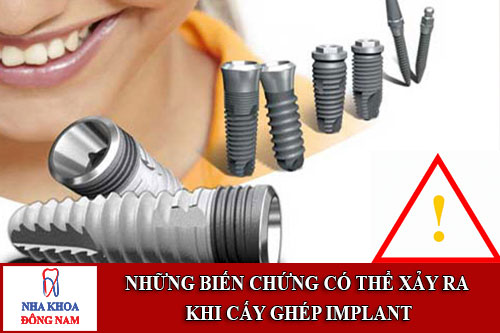 những biến chứng có thể xảy ra khi cấy ghép implant