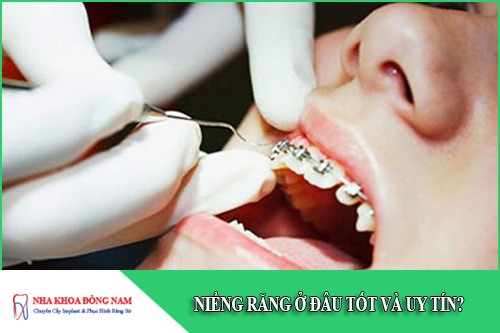 niềng răng ở đâu tốt và uy tín tại tphcm