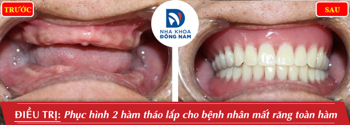 Phục hình bằng hàm giả tháo lăp giúp cải thiện thẩm mỹ, ăn nhai cơ bản