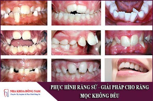 phục hình răng sứ giải pháp cho răng mọc không đều