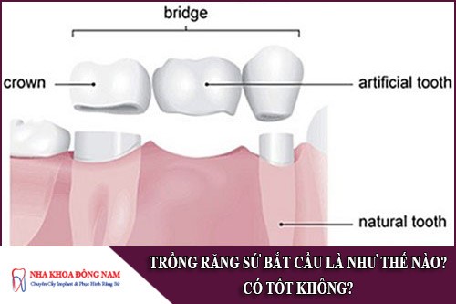 phương pháp trồng răng sứ bắt cầu là như thế nào
