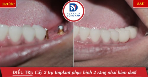 cấy 2 trụ implant răng hàm