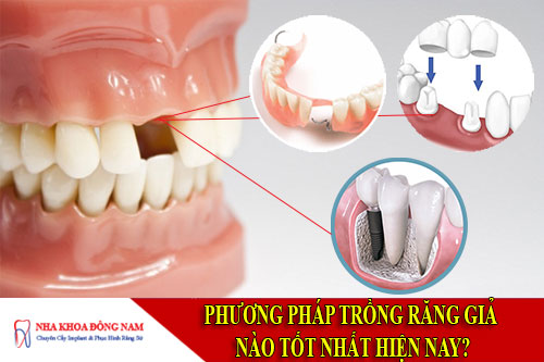 phương pháp trồng răng giả nào tốt nhất hiện nay?