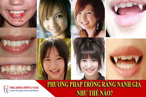 phương pháp trồng răng nanh giả như thế nào?