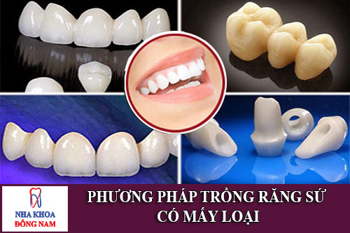 phương pháp trồng răng sứ có mấy loại
