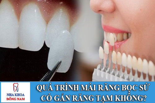 quá trình mài răng bọc sứ có gắn răng tạm không?
