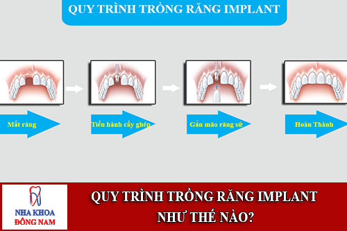 quy trình trồng răng implant như thế nào
