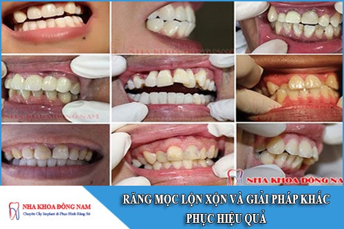 giải pháp khắc phục răng mọc lộn xộn hiệu quả