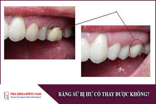 răng sứ bị hư có thay được không