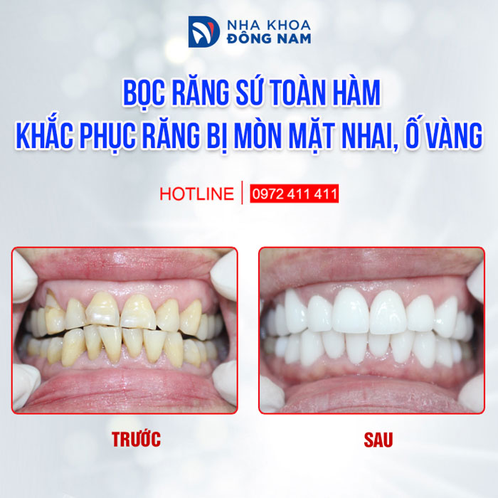 Răng sứ cho màu sắc và hình dáng không có sự khác biệt so với răng thật