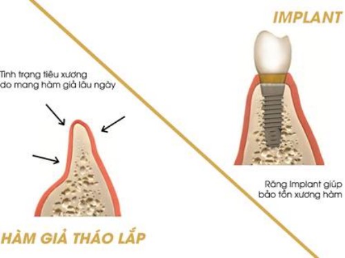 trồng răng giả tháo lắp và implant