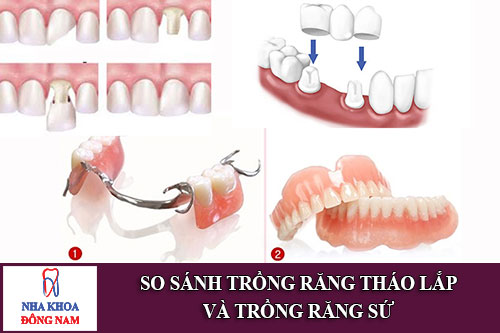 so sánh trồng răng tháo lắp và trồng răng sứ