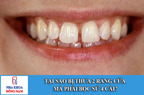 tại sao bị thưa 2 răng cửa mà phải bọc sứ 4 cái?
