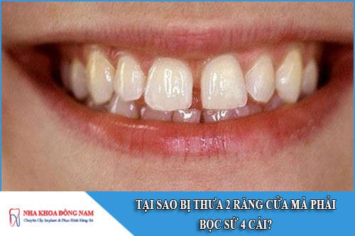 tại sao bị thưa 2 răng cửa mà phải bọc sứ 4 cái