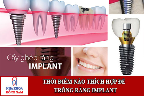 thời điễm nào thích hợp để trồng răng implant