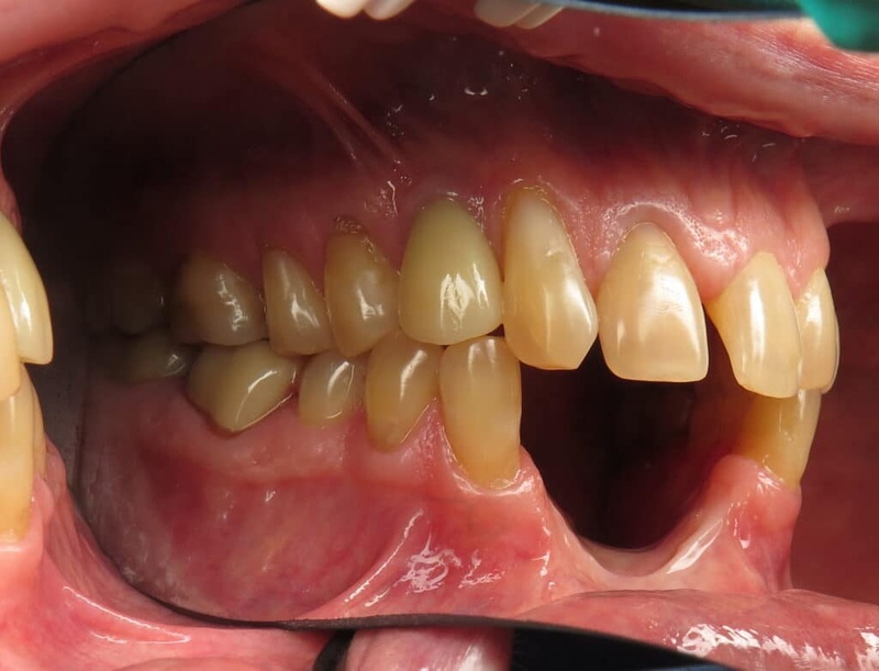 Tình trạng mất răng lâu năm gây tiêu xương, ảnh hưởng thẩm mỹ