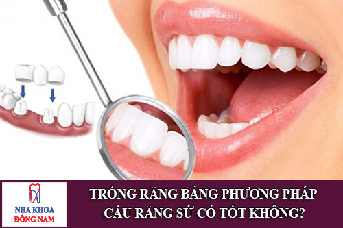 trồng răng bằng phương pháp cầu răng sứ có tốt không