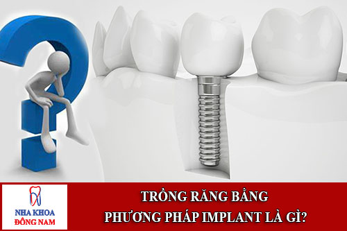 Trồng răng bằng phương pháp implant là gì?