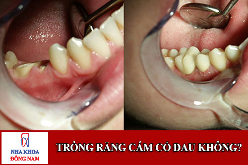 phương pháp trồng răng cấm có đau không