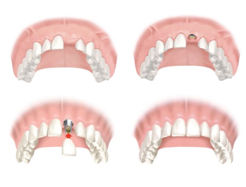 mô phỏng cấy ghép răng implant
